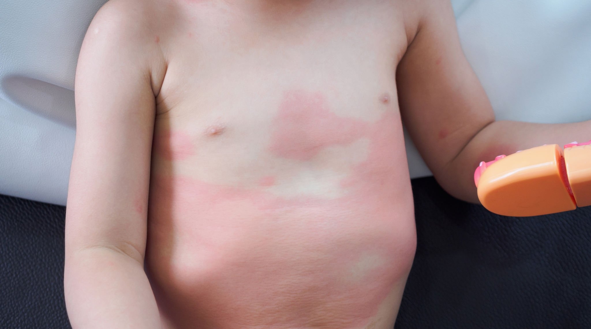 Skin Diseases in Children: Understanding and Preventing Common Conditions